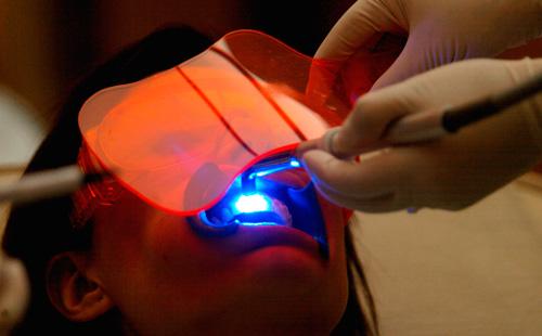 Laser Teeth Whitening