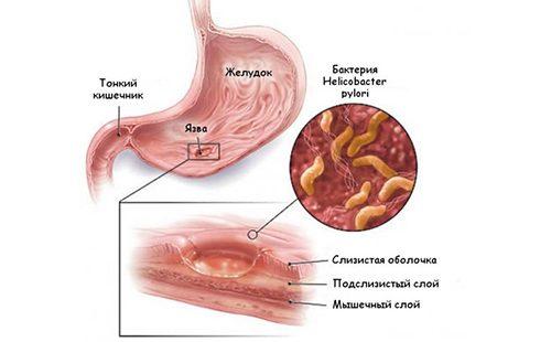 Ipinapakita ng figure ang mekanismo ng pagbuo ng mga gastric ulcers.